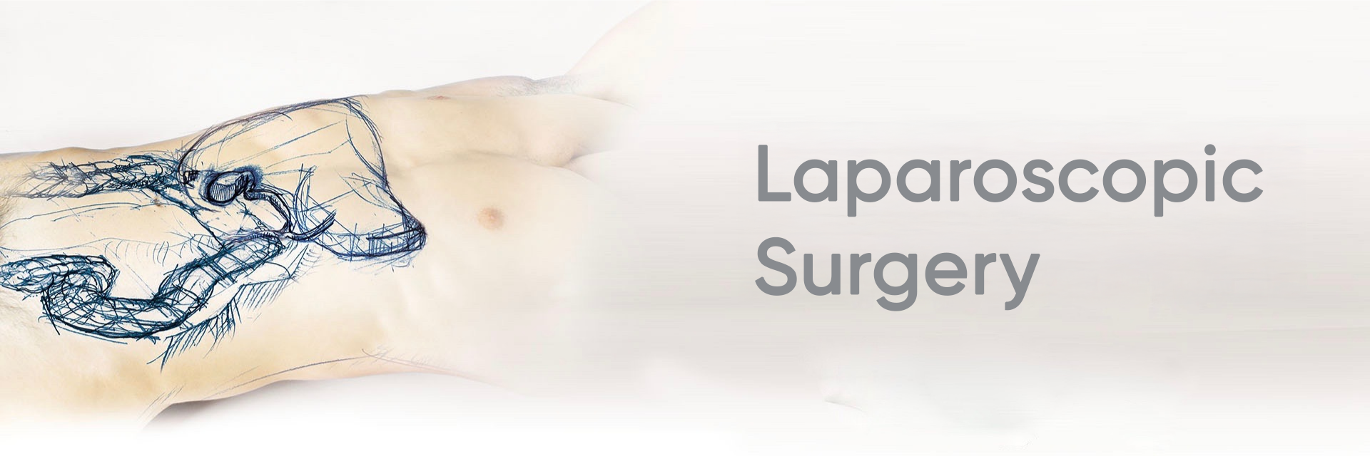 Laparoscopic Surgery